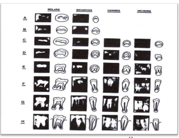 Gambar 3. Gigi insisivus sentralis mandibula permanen kanan dilihat dari beberapa aspek15 