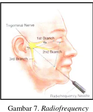 Gambar 7. Radiofrequency  