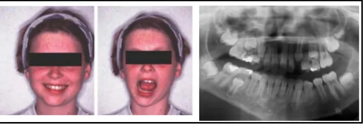 Gambar 9. (a) Hemifacial Microsomia, (b) Foto rontgen pada penderita        Hemifacial Microsomia22 