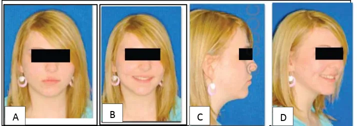 Gambar 4. Fotometri Ekstra oral. (A) Foto frontal dengan bibir relaks, (B) Foto frontal dengan bibir dalam keadaan tersenyum, (C) Foto lateral dengan bibir relaks, (D) Foto profil 45o dengan bibir dalam keadaan tersenyum16 