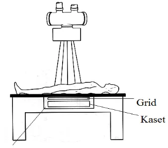 Gambar 2.21. Hasil radiografi grid diam(kiri) dan grid bergerak (kanan) 