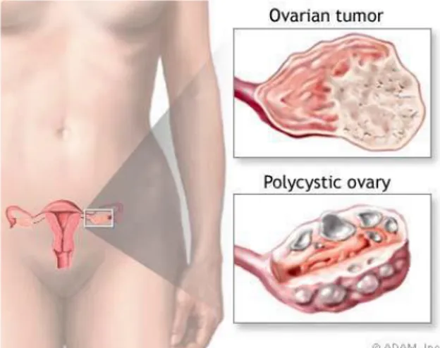 Gambar 4. Tumor ovarium dan sindrom ovarium polikistik. 6 