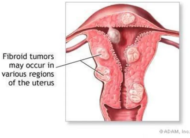 Gambar 5. Lokasi tumor fibroid uterus. 6 