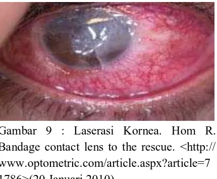 Gambar 9 : Laserasi Kornea. Hom R.  www.optometric.com/article.aspx?article=7Bandage contact lens to the rescue
