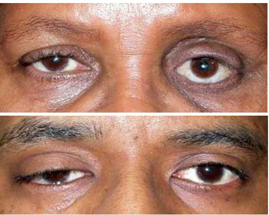 Gambar 10 : Atas : Lower Lid Ptosis; Bawah: Upper lid  Ptosis. Anonymous. . 