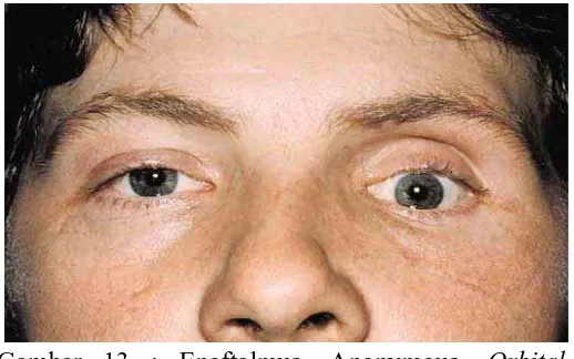Gambar 14 : Hipoglobus. Lucarelli M.  63 year-old woman with enoftalmus.A  Digital Opth J