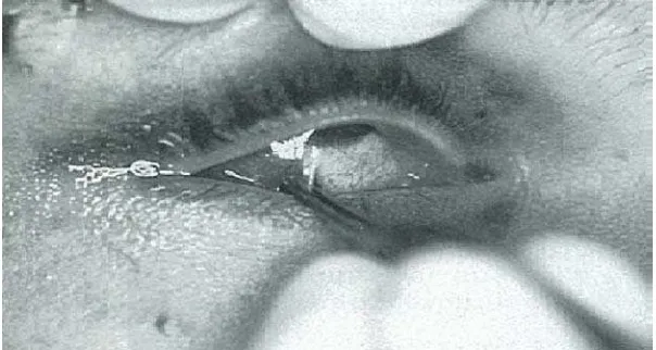 Gambar 16 : Forced duction test. Pasien menunjukkan pergerakan bola mata ke atas yang terbatas