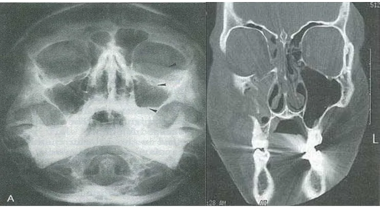 Gambar 17 : A.Proyeksi Water’s. Frakturs dasar orbita dengan tanda herniasi dari periorbita inferior dan level udara  pada sinus kiri