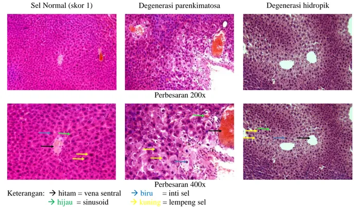 Gambar 2. Kerusakan histologi hati mencit 