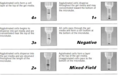 Gambar 2.3 Derajat aglutinasi pada pemeriksaan crossmatch metode gel (Walker  and Harmering, 2012) 