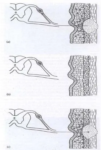 Gambar 7. Manifestasi HSV : a. Infeksi primer; b. Fase laten; c. Infeksi rekuren 