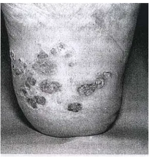 Gambar 8. Veruka plantar 