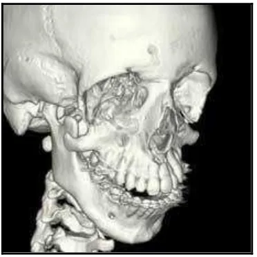 Gambar 5. CT ScanSindroma Treacher Collins tanpa tulang pipi pada  pasien 20 