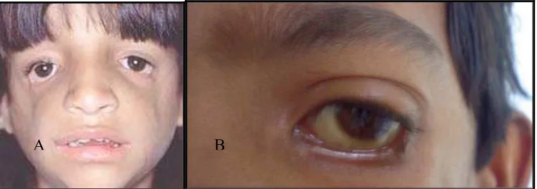 Gambar 6A.  Mata yang miring ke bawah pada Sindroma Treacher Collins26        6B.  Adanya koloboma pada kelopak mata bawah27   