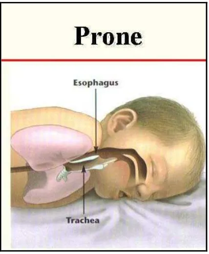 Gambar 9. Bayi dengan posisi prone32