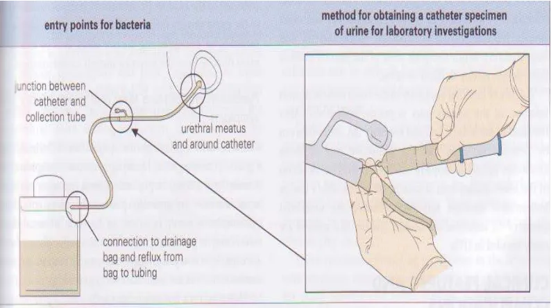 Gambar 3. Pengambilan urin  secara indwelling catheter urine  