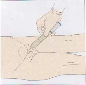 Gambar 4. Pengambilan urin secara Supra Pubic Punction 