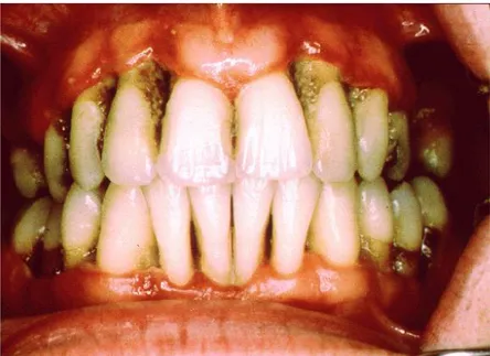 Gambar 2.1 Periodontitis (Sumber: http://mwgdentists.com/periodontitis-101/) 