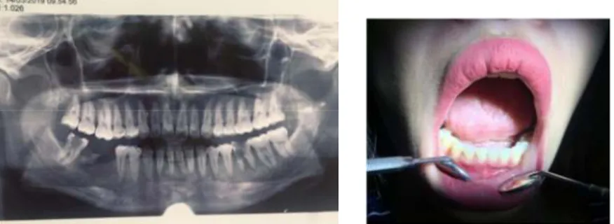 Gambar 3. A. Gambar radiografi tidak ada gambaran radiolusen pada apikal gigi anterior, B