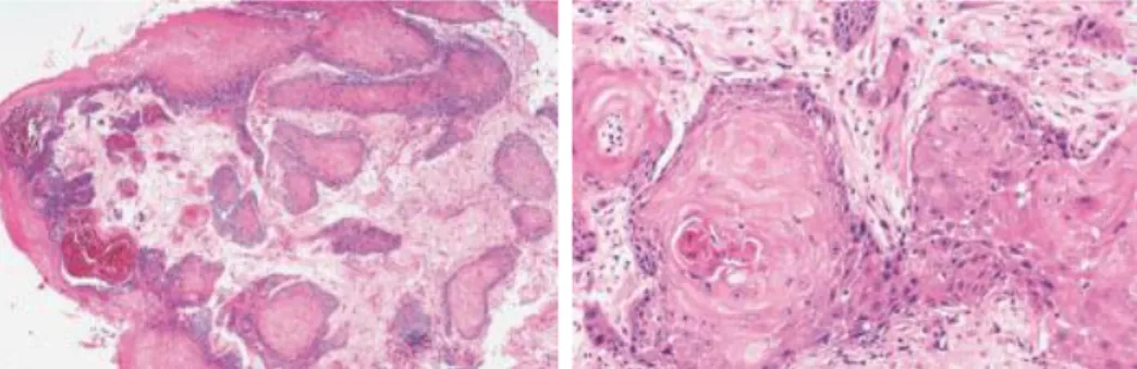 Gambar 2.5.  Gambaran sitologi karsinoma sel skuamous, inti pleomorfik, kromatin  kasar, batas sel jelas, sitoplasma kebiruan