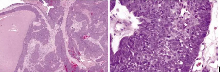 Gambar 2.6.  Nasopharyngeal nonkeratinizing carcinoma, differentiated type. A. 