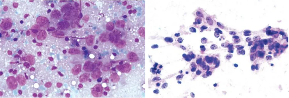 Gambar 2.7. Gambaran sitologi undifferentiated carcinoma. Kelompokan sel-sel epitel  undifferentiated, dengan inti vesikuler, nukleoli menonjol dan sitoplasma pucat dan  rapuh,  dengan latar belakang limfosit.(A