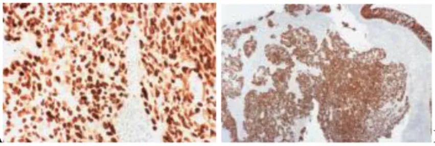 Gambar 2.14. Pewarnaan imunohistokimia pada nonkeratinizing carcinoma  undifferentiated subtype
