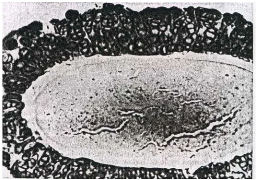 Gambar belahan rambut yang terinfeksi dimana terlihat rambut dikelilingi oleh berlapis-lapis arthrospora