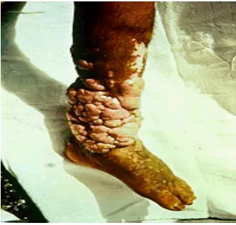 Gambar 7:  lesi lobomycosis.7