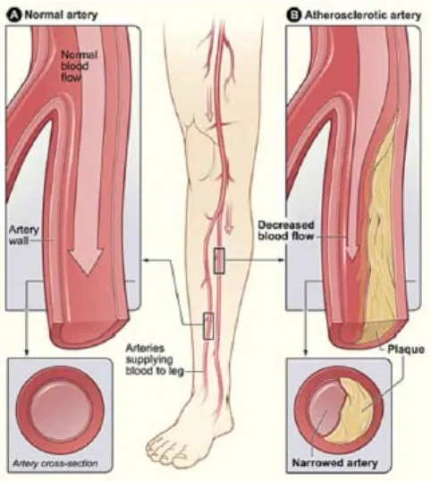 Gambar 4. Peripheral arterial disease 