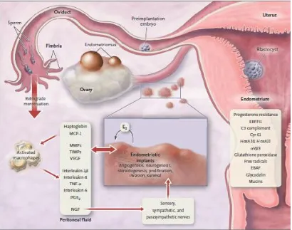 Gambar 1.Patofisiologi Endometriosis4 