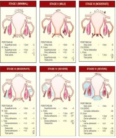 Gambar 2 . Klasifikasi Endometriosis .12 