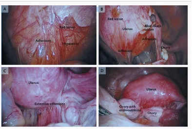 Gambar 4.Lesi Peritoneum Endometriosis.4 