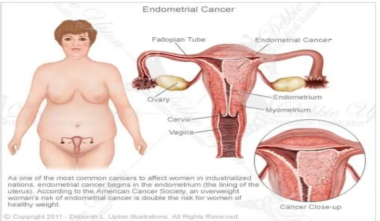 Gambar 2.1. Kanker endometrium 
