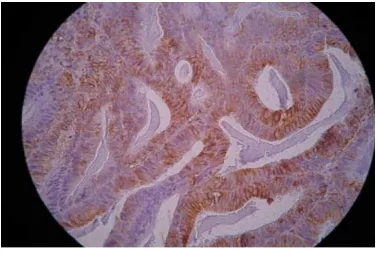 Gambar 2.4. Pewarnaan vimentin pada adenokarsinoma endometrium 