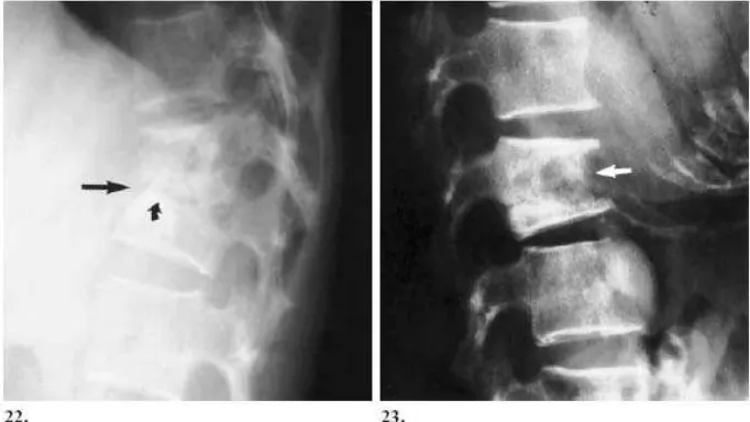 Gambar 6. Foto Polos Vertebra pada Spondilitis Tuberkulosa 