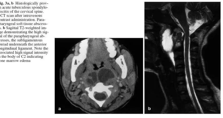 Gambar   7. Gambaran MRI Spondilitis  Tuberkulosa  