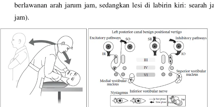 Gambar 2.6 Pola nistagmus pada kanalis semisirkularis posterior telinga kiri (Hornibrook, 2011) 