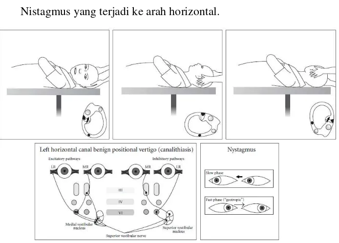 Gambar 2.7 Pola nistagmus pada kanalis semisirkularis anterior telinga kiri (Hornibrook, 2011) 
