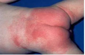 Gambar 2.3 : Dermatitis Numularis 