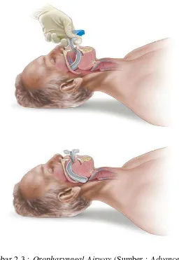 Gambar 2.3 : Oropharyngeal Airway (Sumber : Advance Trauma Life 