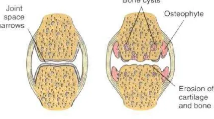 Gambar 2.1 Osteoarthritis Sumber : Goodman & Fuller (2009) 