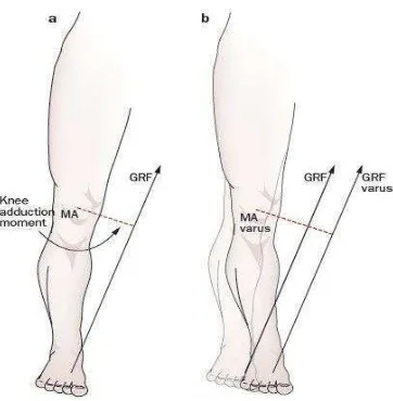Gambar 2.4 Ruang sendi pada osteoarthritis  dan pada lutut normal 