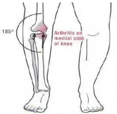 Gambar 2.5. Pembebanan selama berjalan pada osteoarthritis Sumber : Neumann (2009) 