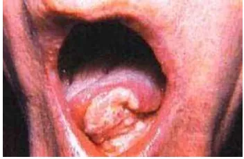 Gambar 13. Kanker di rongga mulut23 