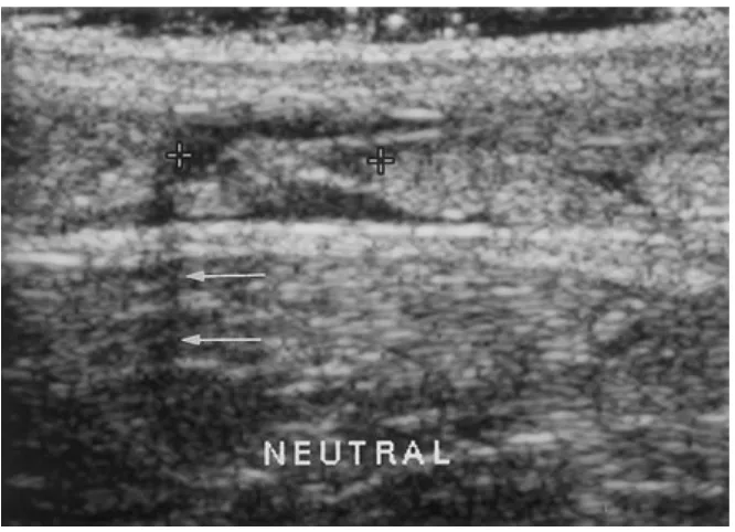 Gambar 2.4: Gambaran ruptur tendon Achilles dengan plain radiograph