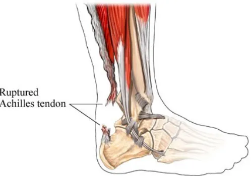 Gambar 2.1: Ruptur Tendon Achilles 