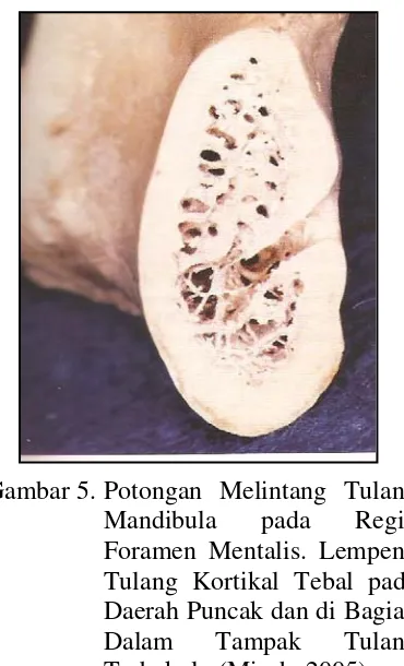 Gambar 5. Potongan Melintang Tulang Mandibula pada Regio Foramen Mentalis. Lempeng Tulang Kortikal Tebal pada Daerah Puncak dan di Bagian Dalam Tampak Tulang Trabekula  (Misch, 2005) 
