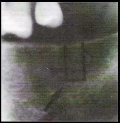 Gambar 6. Pola Trabekula Tulang Grade 1  (Taguchi, 1997)  