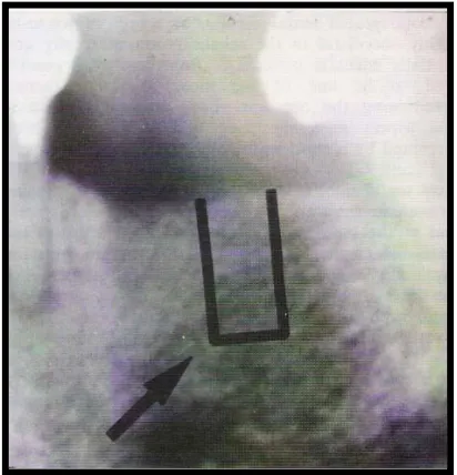 Gambar 9. Pola Trabekula Tulang Grade 4 (Taguchi, 1997) 